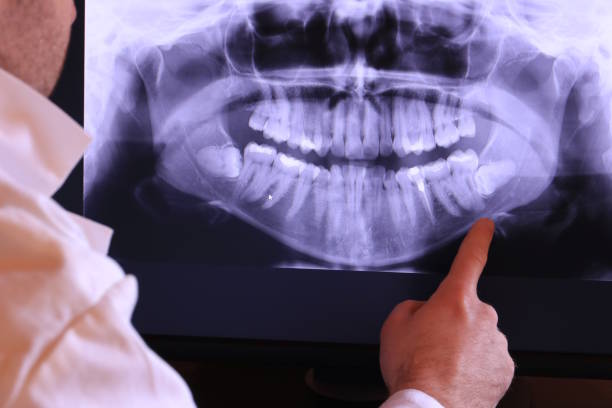 Best Emergency Wisdom Tooth Extraction in San Bruno, CA