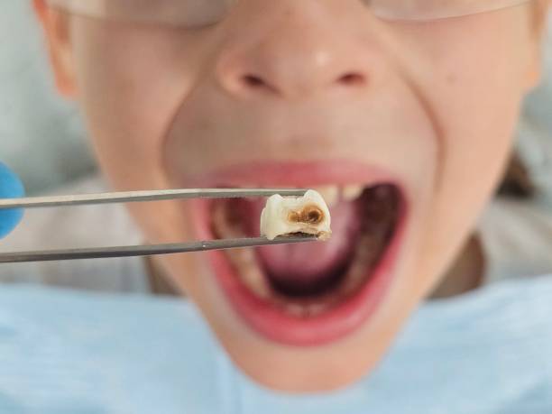 Best Broken or Chipped Tooth Repair in San Bruno, CA