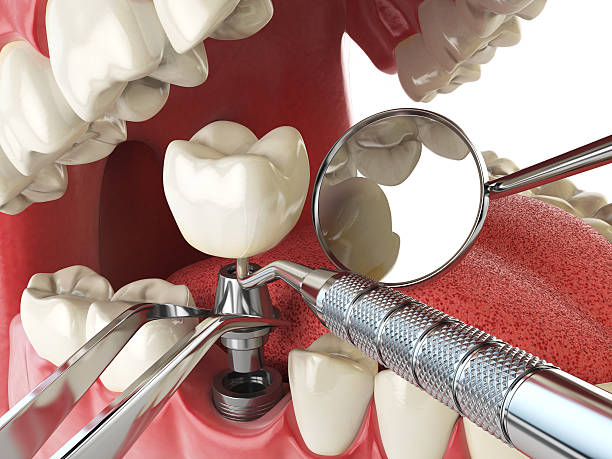 Best Emergency Cosmetic Dentistry (e.g., broken veneers) in San Bruno, CA